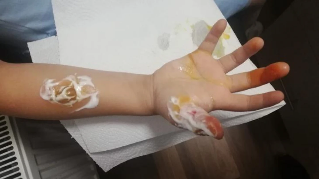 Kadıköy'de hastanede MR çekilen küçük kızın parmakları ve kolu yandı