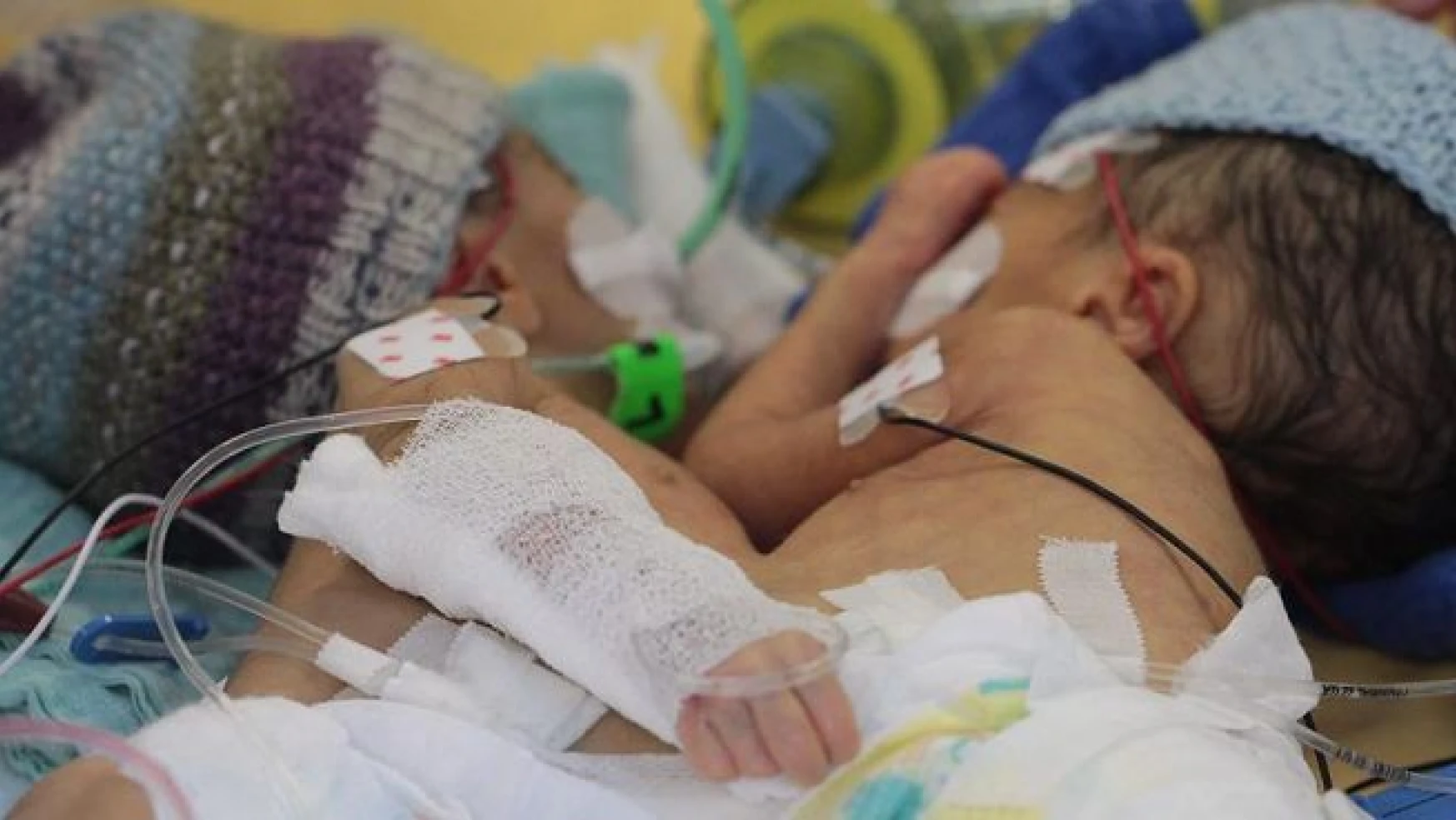 İsviçre'de 8 günlük yapışık ikizler ameliyatla ayrıldı