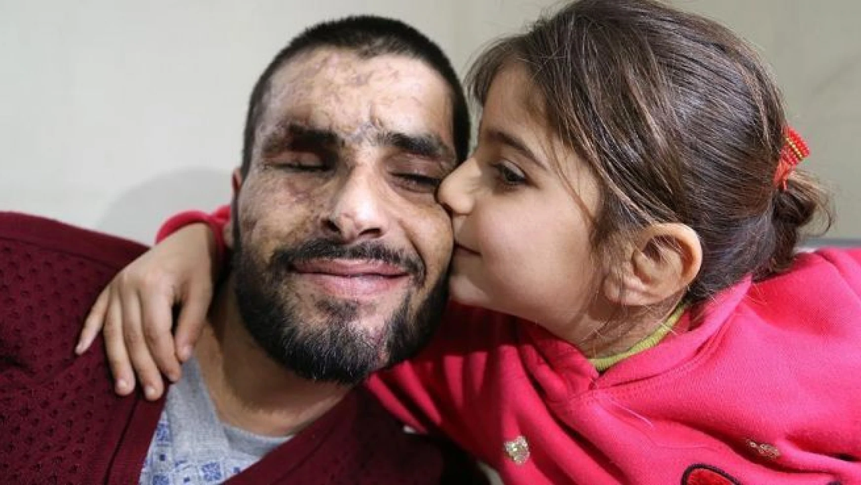 Suriye'de gözlerini, iki bacağını ve işitme yetisini kaybetti, Türkiye'de ise...