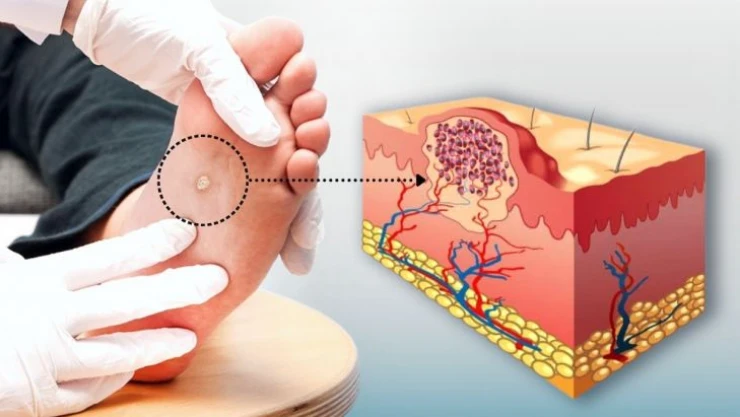 Siğiller kâbusunuz olmasın