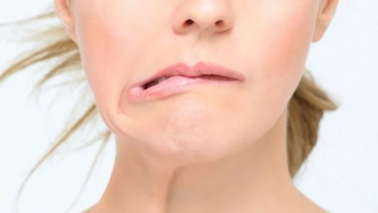 Uzmanından yüz felcine karşı öneriler